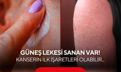 "Sadece güneş lekesi" deyip geçmeyin! Kanserin ilk işaretleri olabilir...