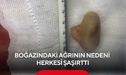 Yutma güçlüğü şikayetiyle gitti... Doktorlar şaşkına döndü! Yemek borusunda 4 santimlik kemik bulundu