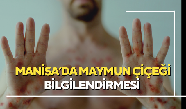 Manisa'da, Maymun Çiçeği bilgilendirmesi