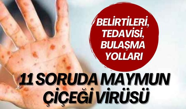 Belirtileri, tedavisi, bulaşma yolları... 11 soruda maymun çiçeği virüsü