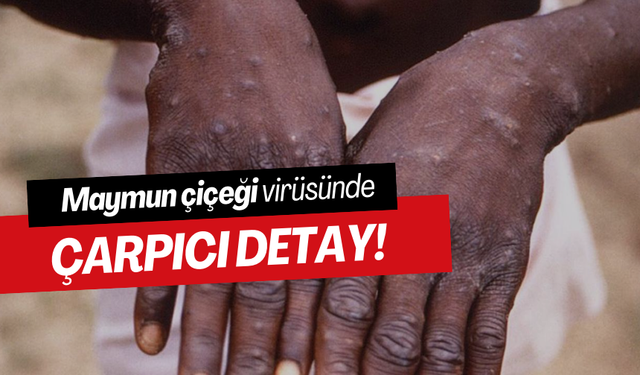 Maymun çiçeği virüsünde çarpıcı detay!