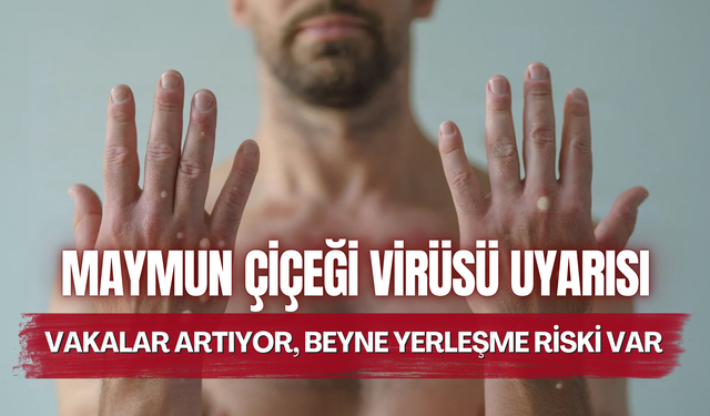 Maymun çiçeği virüsü uyarısı! Vakalar artıyor, beyne yerleşme riski var