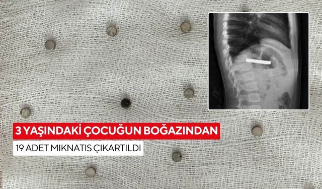 Nefes kesen operasyon: 19 mıknatıs minik çocuğun yemek borusundan alındı