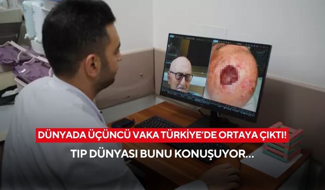 Dünyada sadece iki kez görüldü! Üçüncü vaka Türkiye’de ortaya çıktı