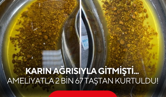 Karın ağrısıyla gitmişti... Ameliyatla 2 bin 67 taştan kurtuldu!