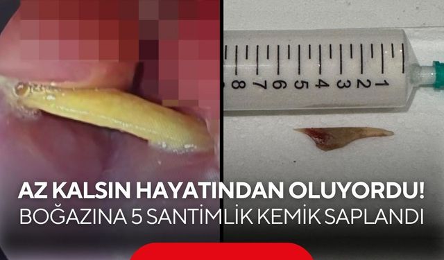 Az kalsın hayatından oluyordu! Boğazına 5 santimlik kemik saplandı