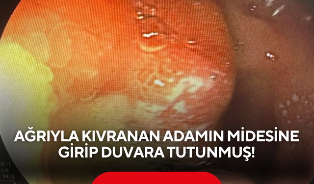Böyle vaka nadir görülür! Ağrıyla kıvranan adamın midesine girip duvara tutunmuş