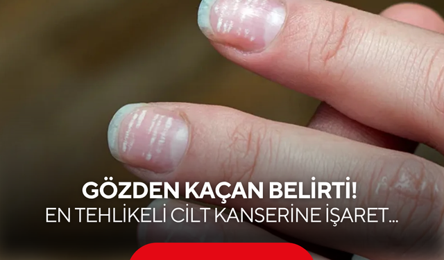 Gözden kaçan belirti! En tehlikeli cilt kanserine işaret edebilir