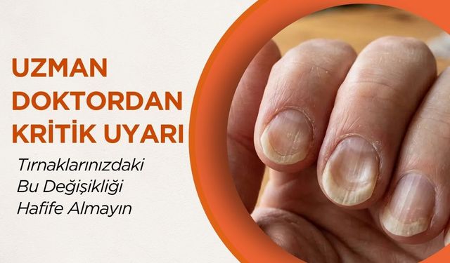 Uzman Doktordan Kritik Uyarı: Tırnaklarınızdaki Bu Değişikliği Hafife Almayın