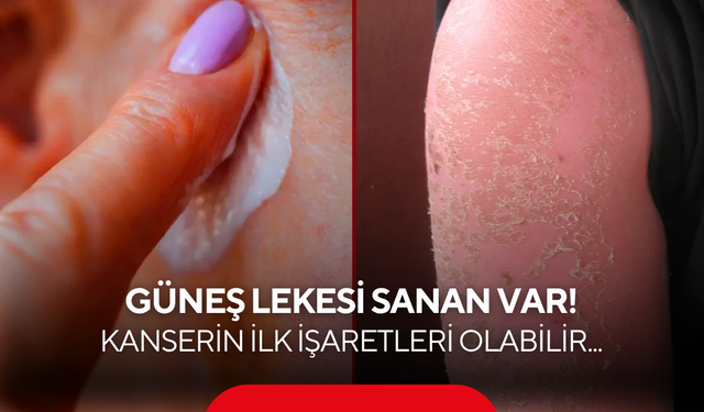 "Sadece güneş lekesi" deyip geçmeyin! Kanserin ilk işaretleri olabilir...