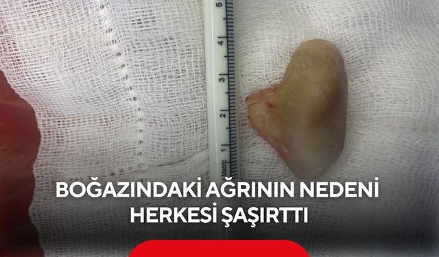 Yutma güçlüğü şikayetiyle gitti... Doktorlar şaşkına döndü! Yemek borusunda 4 santimlik kemik bulundu