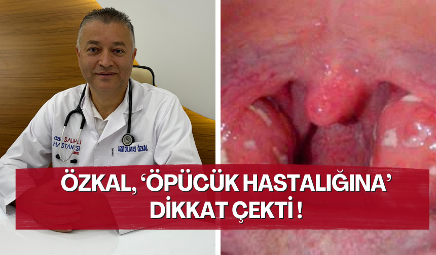 Viral enfeksiyonlara dikkat ! Öpücük hastalığı nedir ? İşte belirtileri, nedenleri ve tedavi yöntemleri