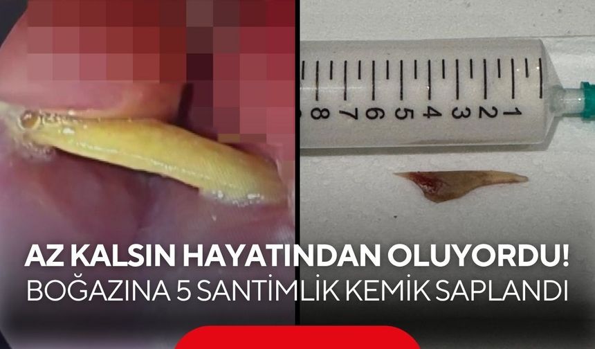 Az kalsın hayatından oluyordu! Boğazına 5 santimlik kemik saplandı