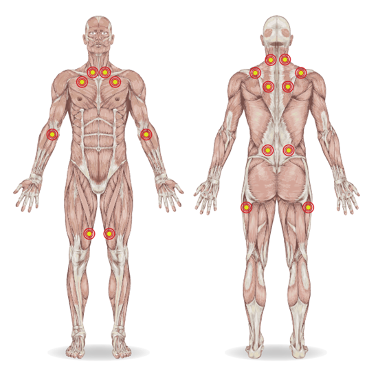 fibromiyalji-nedir-2