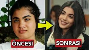 Lizge Cömert öncesi sonrası estetik iddiaları: Eski ve yeni hali arasındaki dikkat çeken farklar.