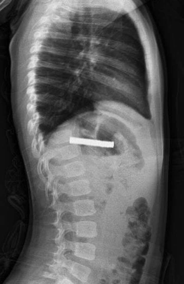 Nefes Kesen Operasyon 19 Mıknatıs Minik Çocuğun Yemek Borusundan Alındı (2)
