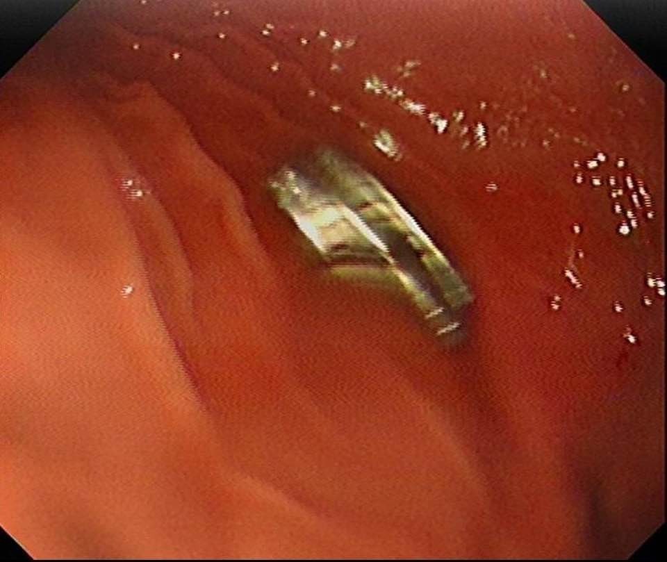 Nefes Kesen Operasyon 19 Mıknatıs Minik Çocuğun Yemek Borusundan Alındı (3)