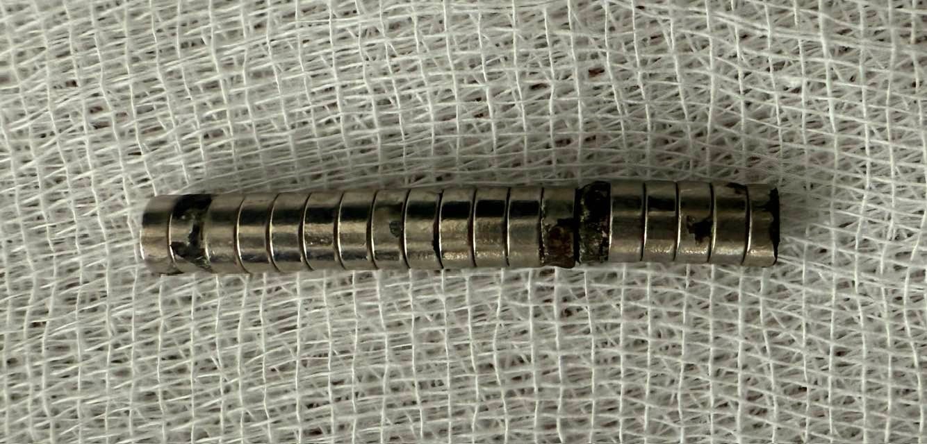 Nefes Kesen Operasyon 19 Mıknatıs Minik Çocuğun Yemek Borusundan Alındı (4)