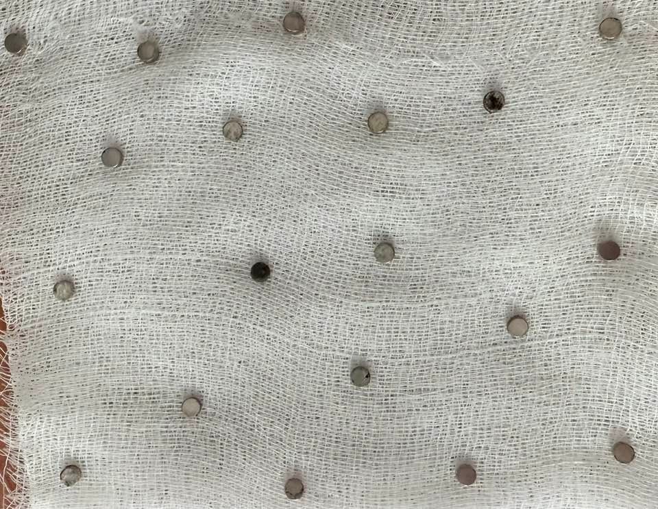 Nefes Kesen Operasyon 19 Mıknatıs Minik Çocuğun Yemek Borusundan Alındı (5)