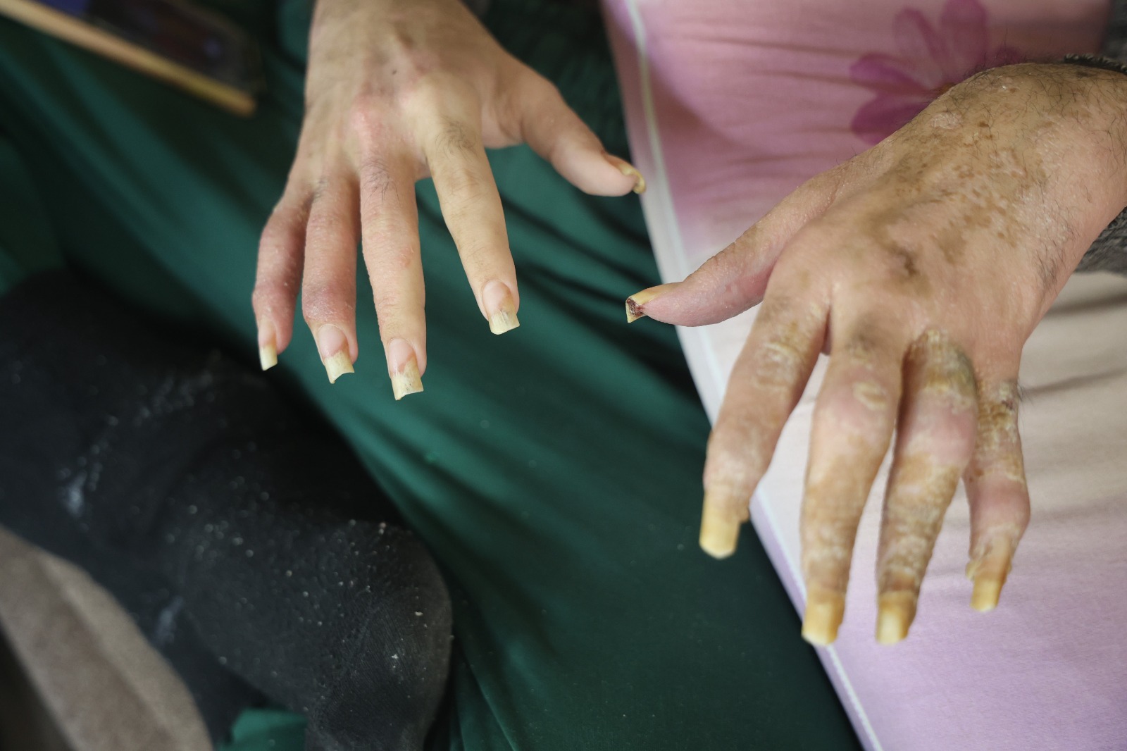 Üç Yıldır Ne Dışarı Çıktı Ne De Banyo Yaptı “Öleceğim” Diyen 23 Yaşındaki Genç, Hayattan Umudunu Kesti (6)