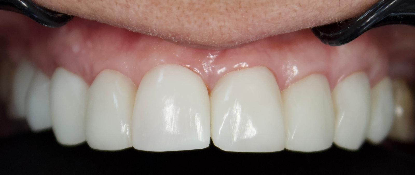 Depremlerden Ilham Aldı Cam Fiber Tekniğiyle Implant Dönemi Sona Eriyor (3)