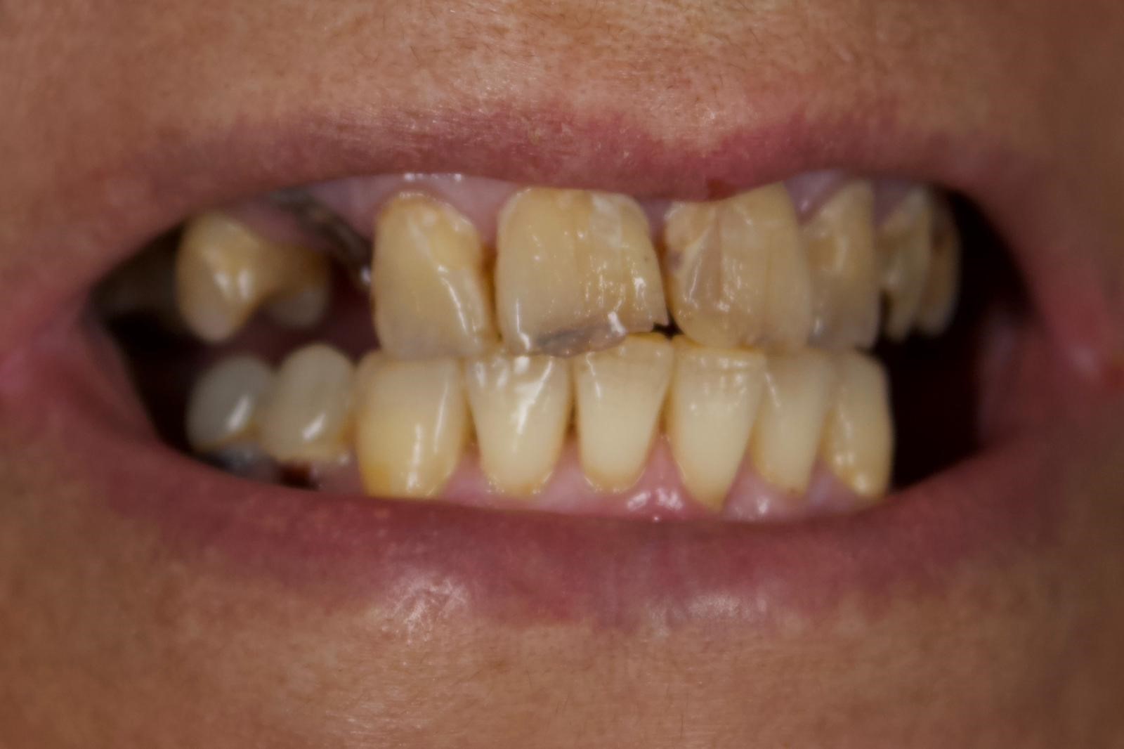 Depremlerden Ilham Aldı Cam Fiber Tekniğiyle Implant Dönemi Sona Eriyor (6)