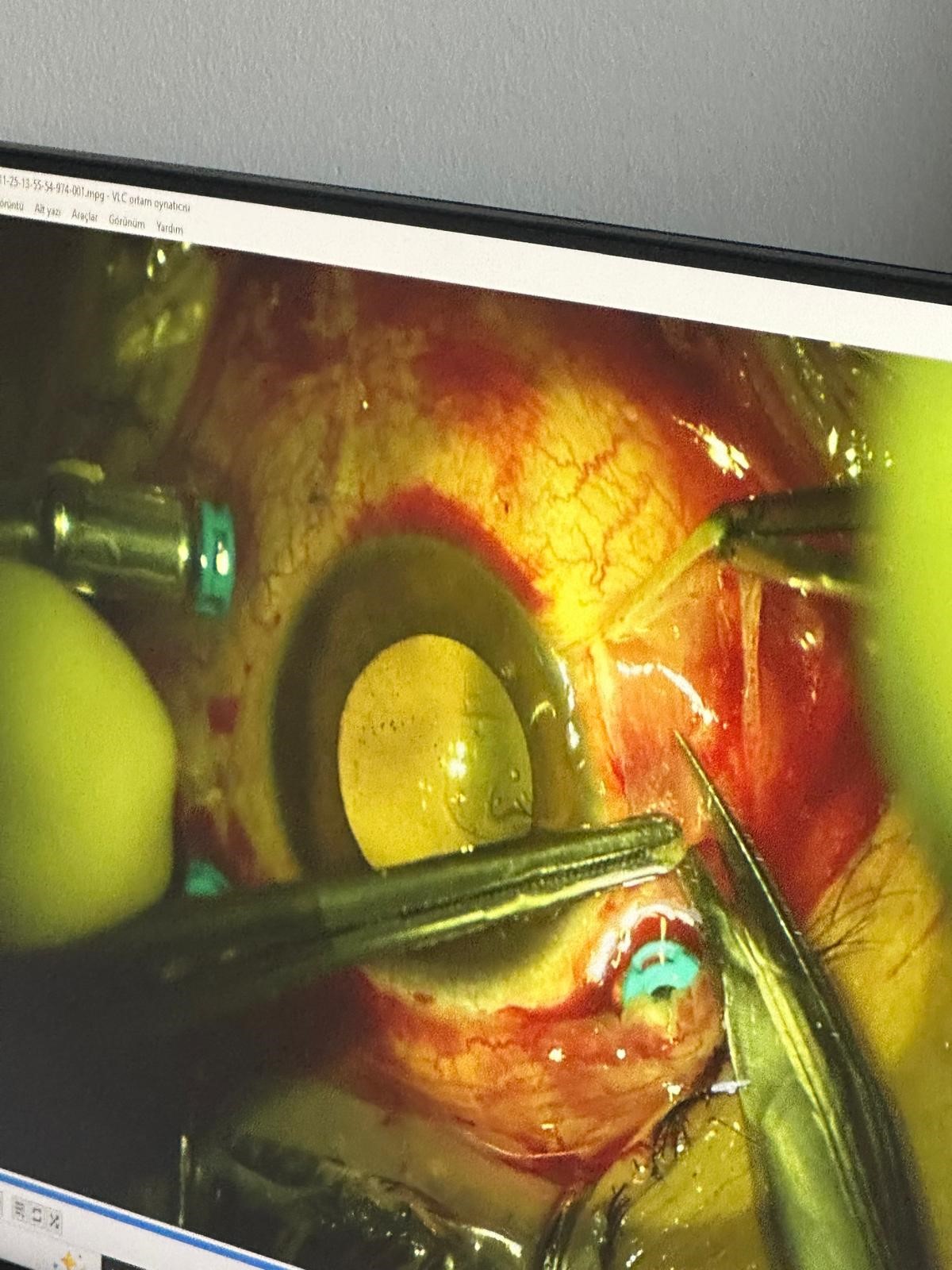 Korkunç Olay! Kayınbaba Dehşet Saçtı! Damadını Gözünden Vurdu (3)