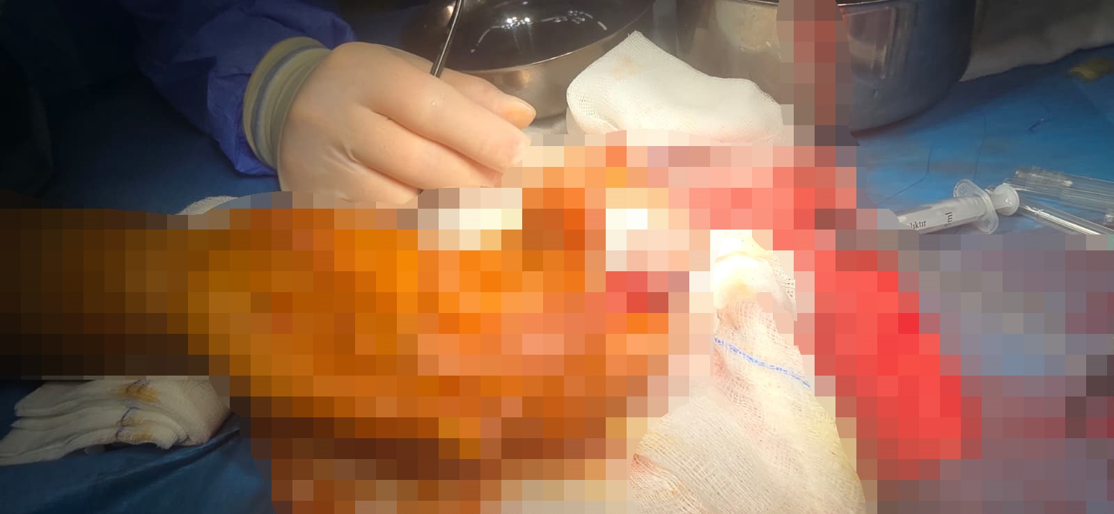 Kopan Parmağını Buzda Sakladı, 600 Kilometre Yol Geldi 14 Saat Sonra Mucize (4)