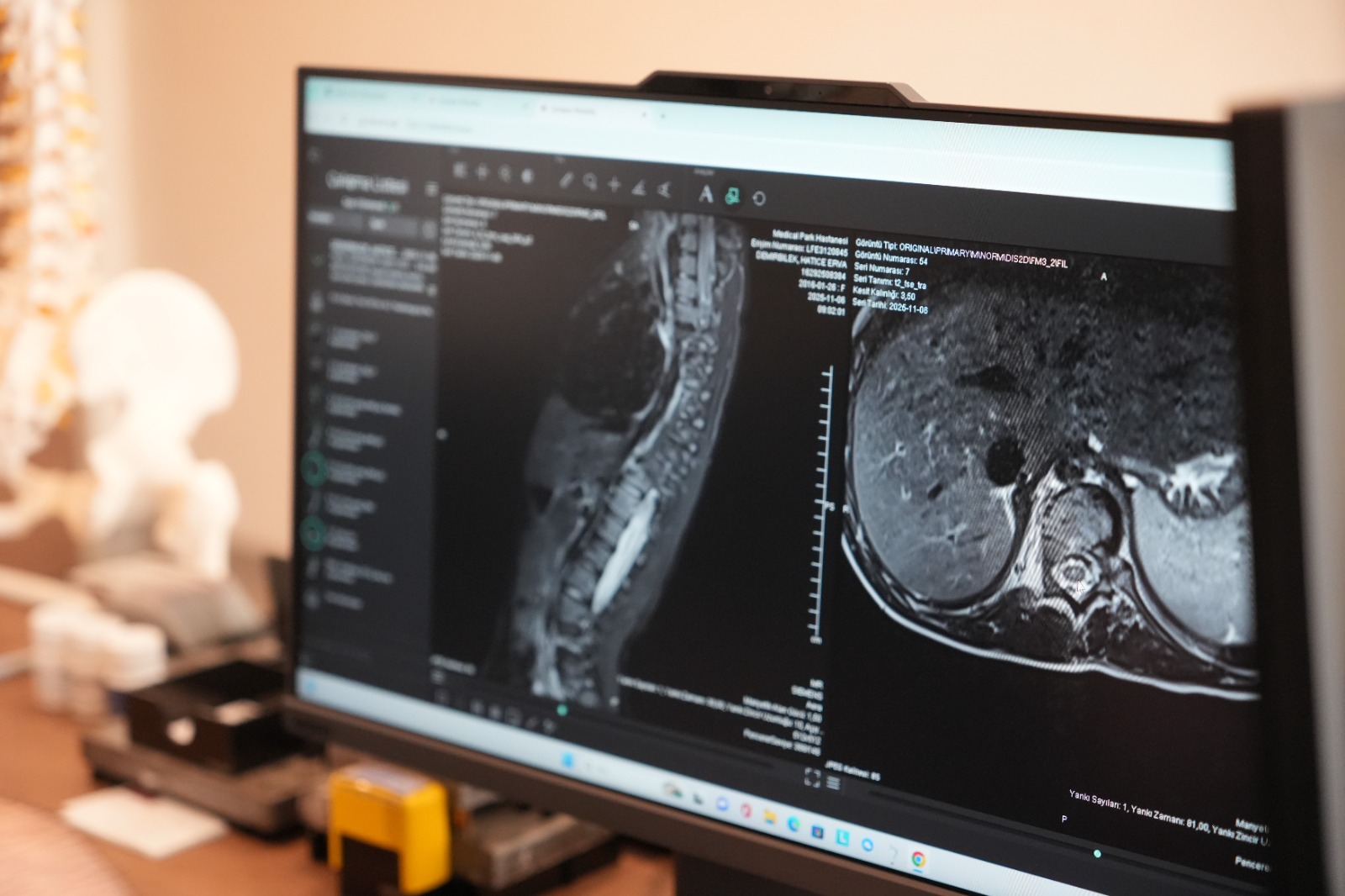 Omurgadaki Gizli Tehlike Skolyoz Erken Yakalanmazsa Büyüyor (1)-2
