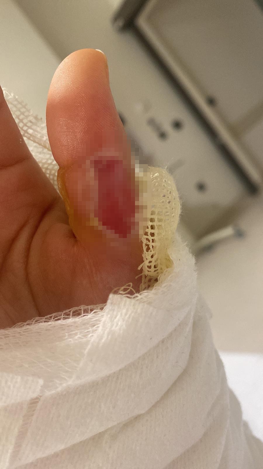 Rahatlamak Isterken Hayatının Şokunu Yaşadı! Sıcak Su Torbası Patladı, Genç Kadın Ölümden Döndü (2)