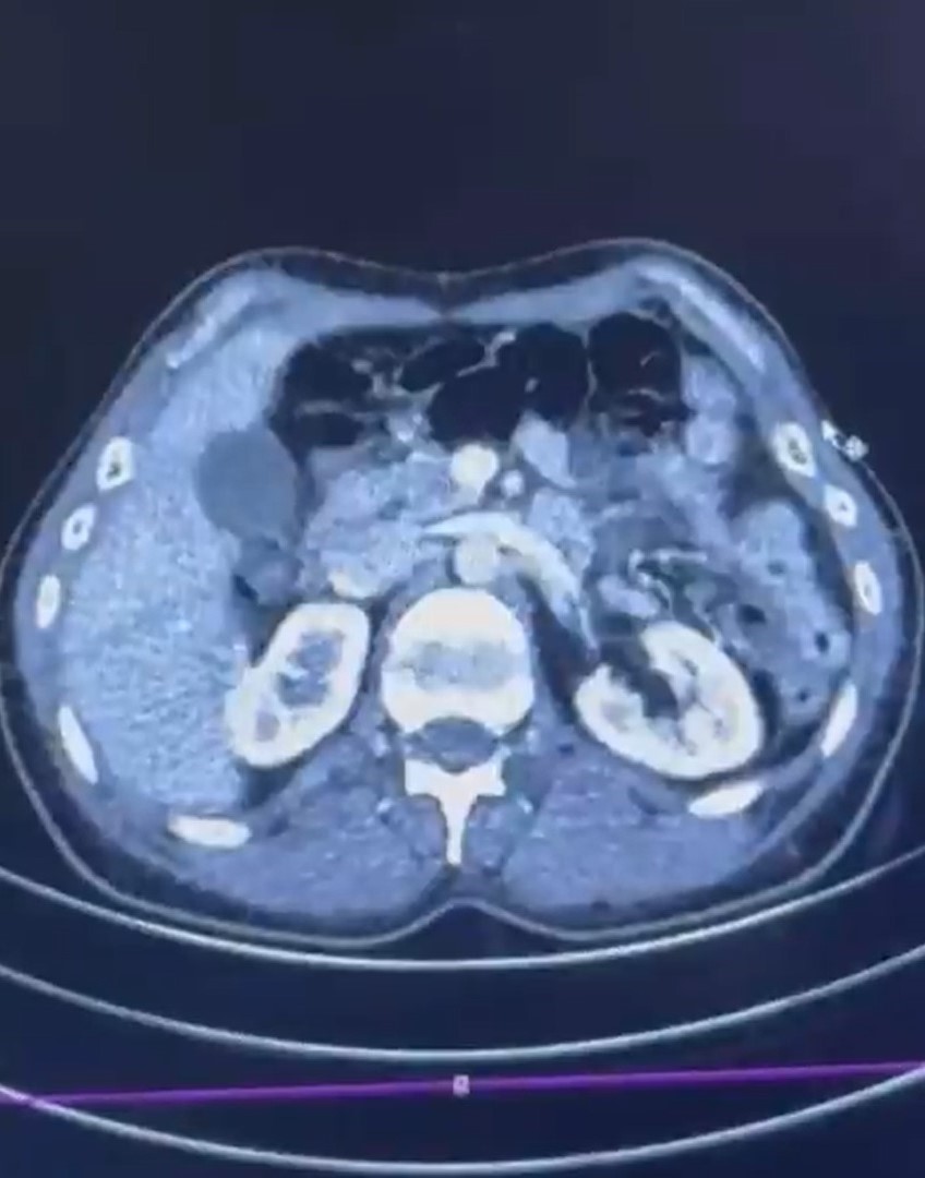Uyuşturucuyu Midelerinde Taşıdılar Nefes Kesen Operasyonla Yakalandılar (2)