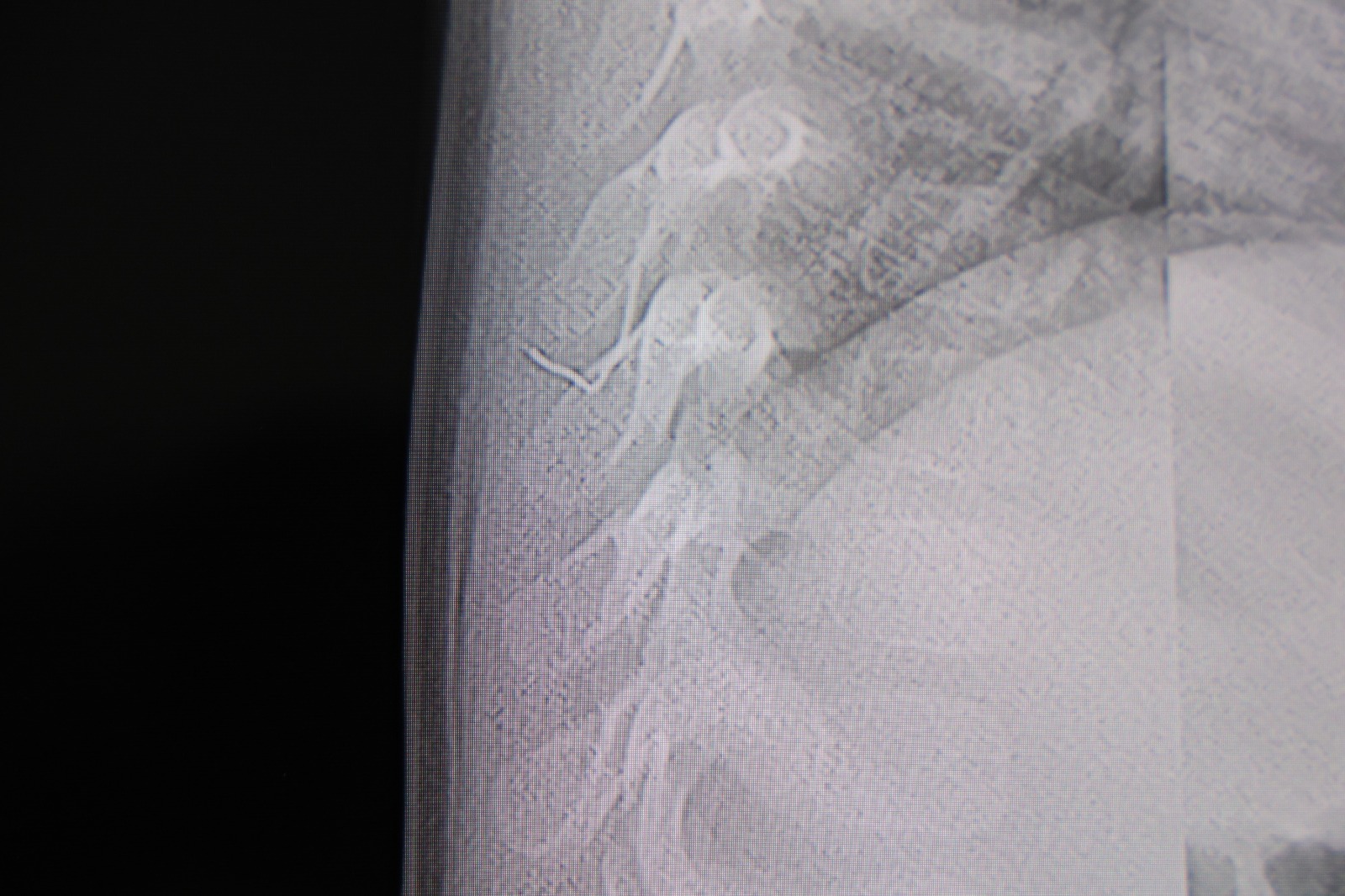 Bebeğin Huzursuzluğunun Nedeni Şoke Etti Akciğere Ilerleyen Zımba Teli (1)-2