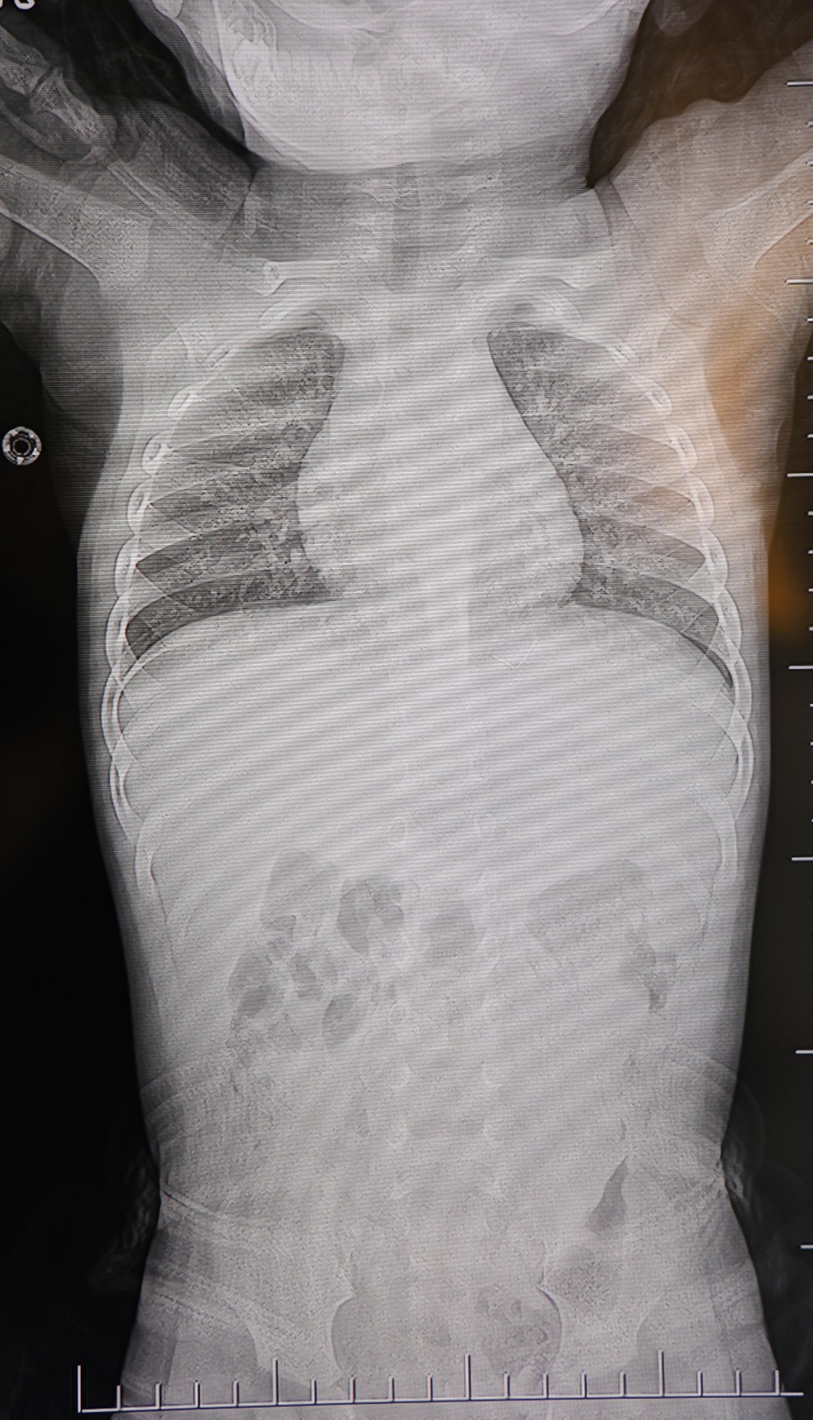 Bebeğin Huzursuzluğunun Nedeni Şoke Etti Akciğere Ilerleyen Zımba Teli (3)