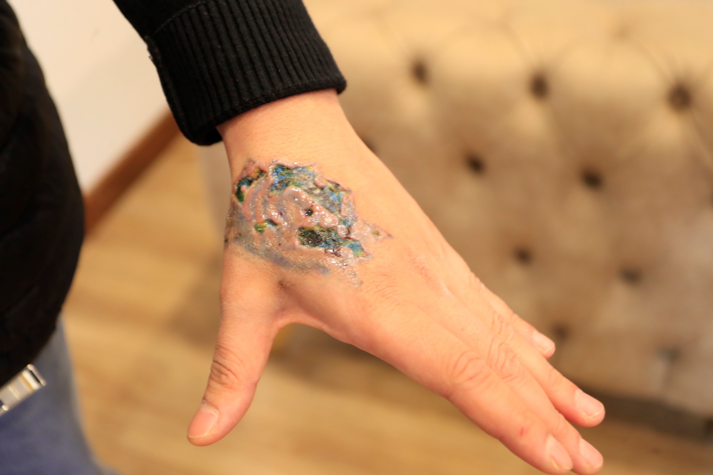 Dövme Silme Işlemi Faciayla Sonuçlandı! Lazer Işlemi Sonrası Elinde Ağır Hasar (4)