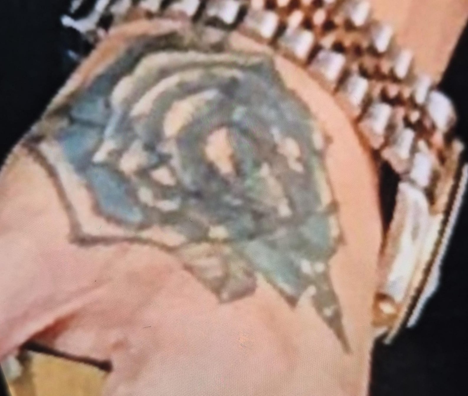 Dövme Silme Işlemi Faciayla Sonuçlandı! Lazer Işlemi Sonrası Elinde Ağır Hasar (5)