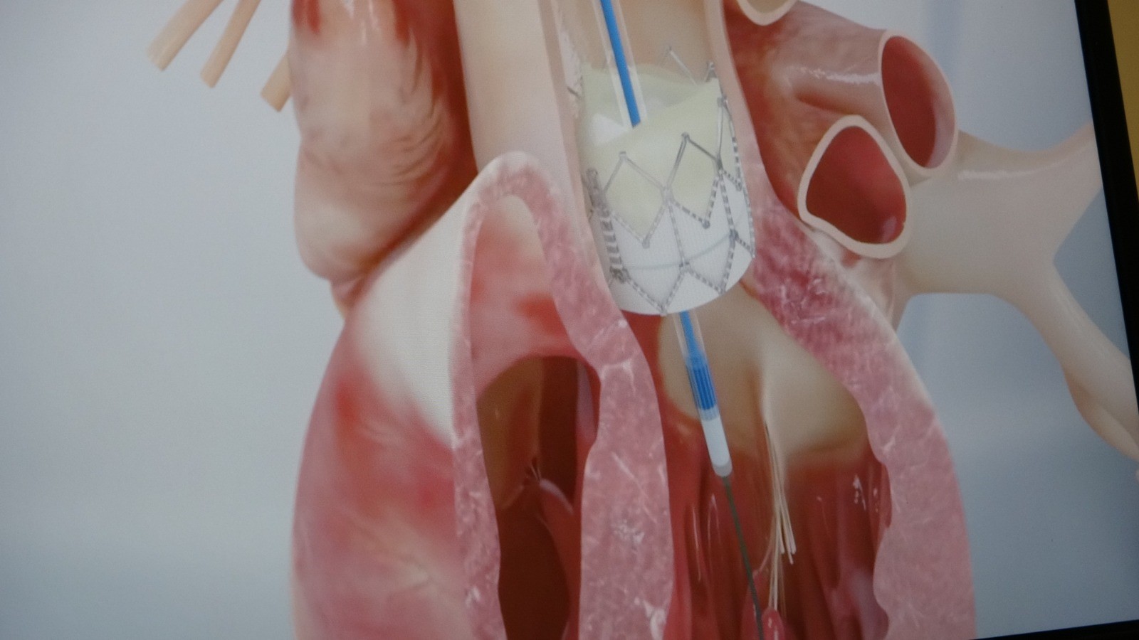 Kalp Krizi Saniliyor Ama Degil Genc Yasta Ani Olumlerin Asil Nedeni Ortaya Cikti (3)