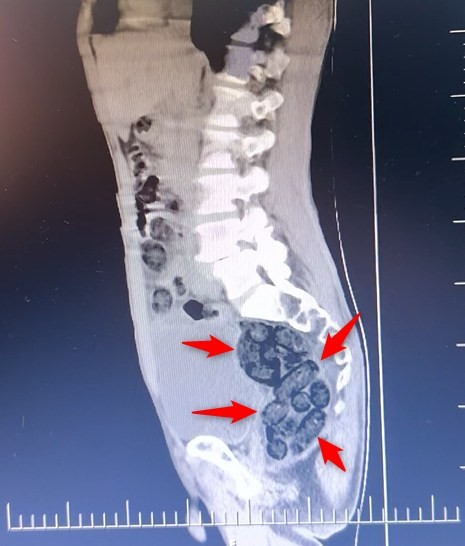 Midesini Zehir Deposuna Cevirmis Tam 64 Paket Tek Tek Icinden Cikardilar (4)