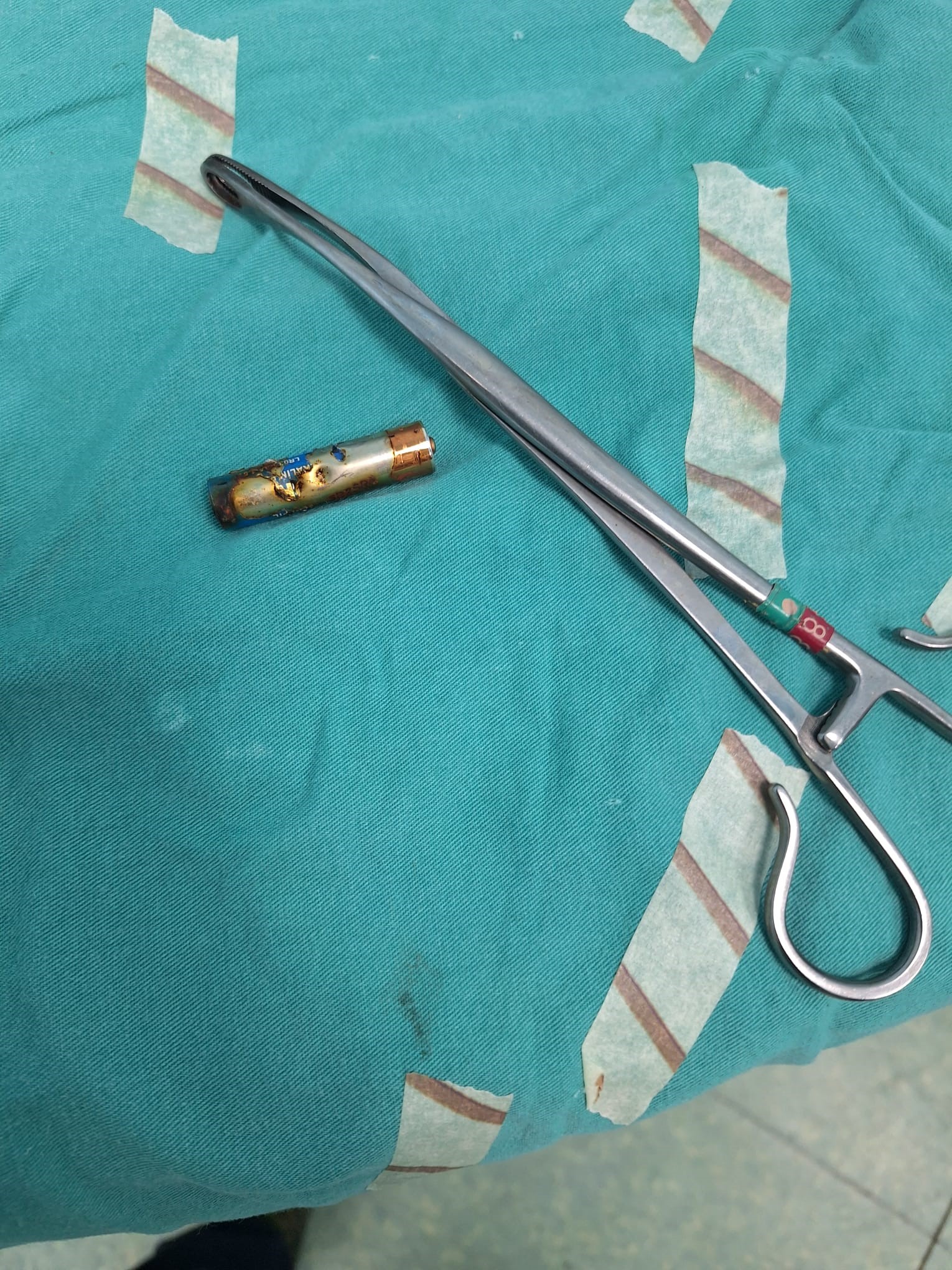 Olumle Burun Buruna Geldi 6 Aylik Bebegin Bogazindan Kumanda Pili Cikti (2)