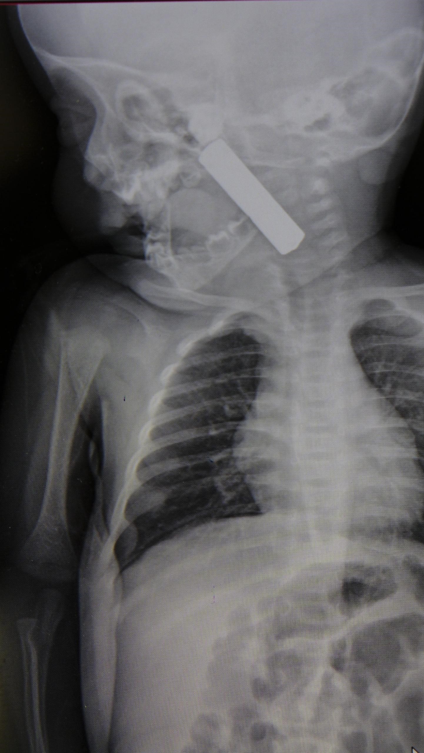 Olumle Burun Buruna Geldi 6 Aylik Bebegin Bogazindan Kumanda Pili Cikti (3)