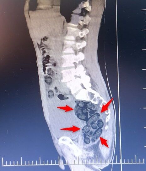 Uyuşturucu Kuryesinin Tehlikeli Yöntemi Deşifre Oldu! Midesinden 64 Parça Uyuşturucu Çıktı (2)