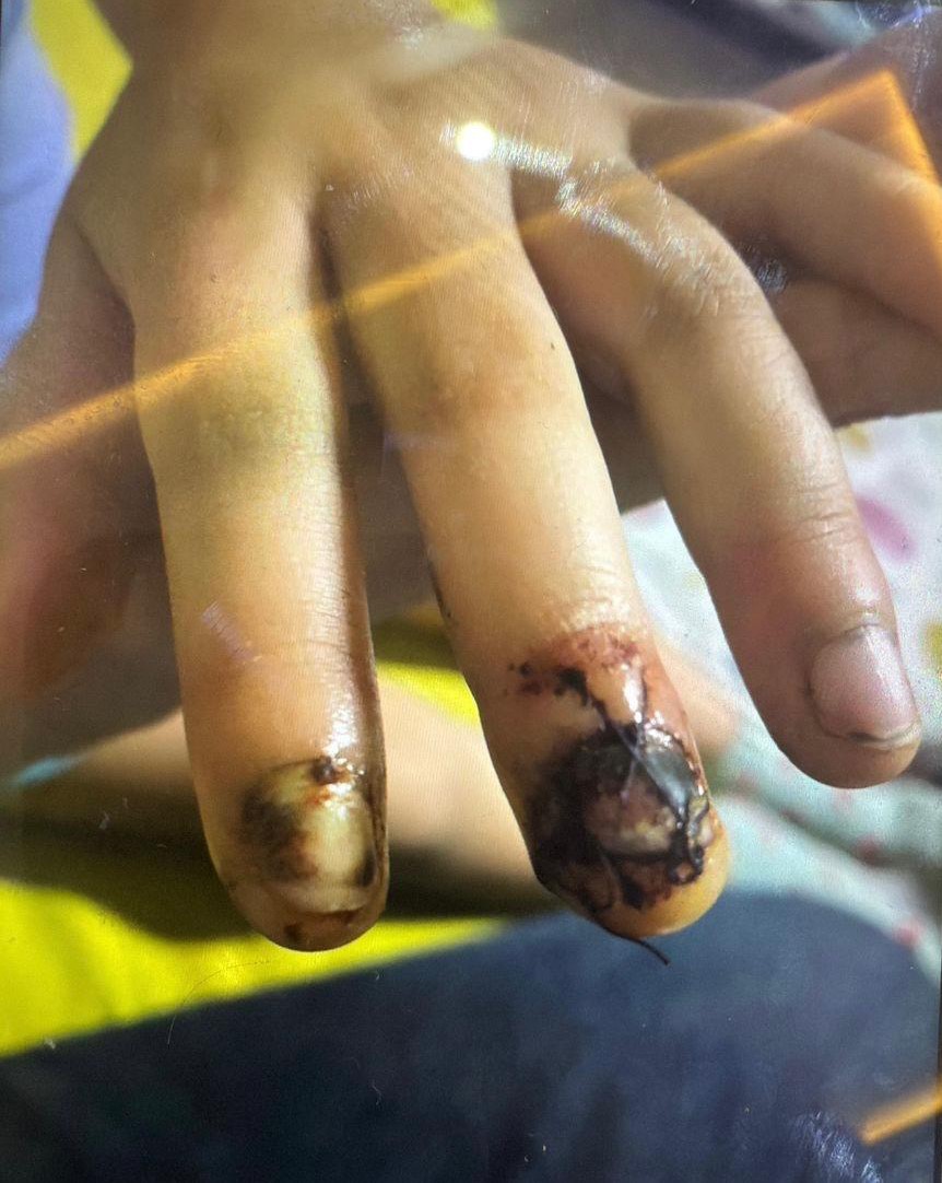 Okulda Korkunç Ihmal Devrilen Masa Küçük Çocuğun Parmaklarını Ezdi (3)