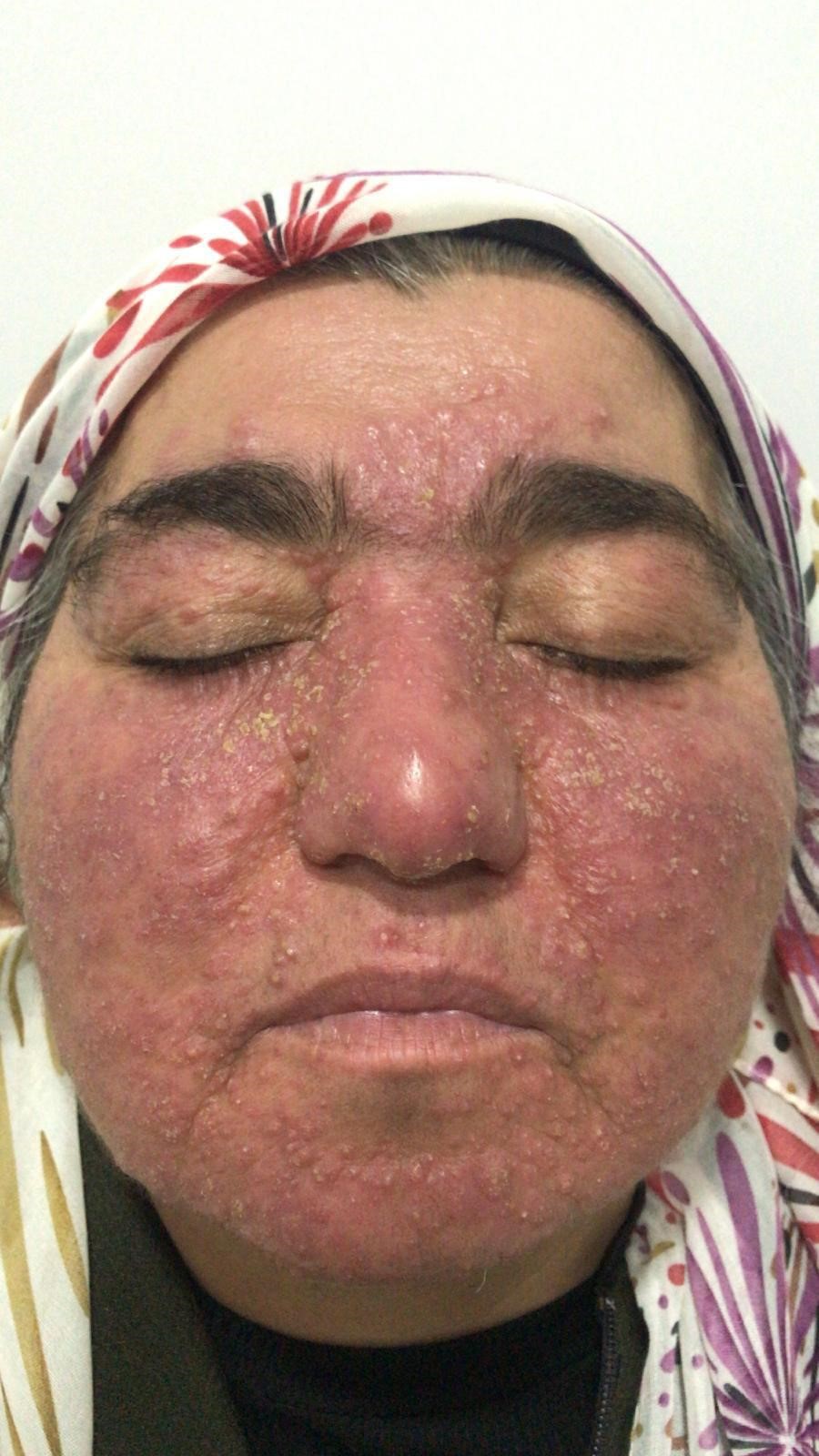 Yıllarca Saklandı, Sessiz Çilesi Sona Erdi! Aylar Süren Tedaviyle Hayata Döndü (3)