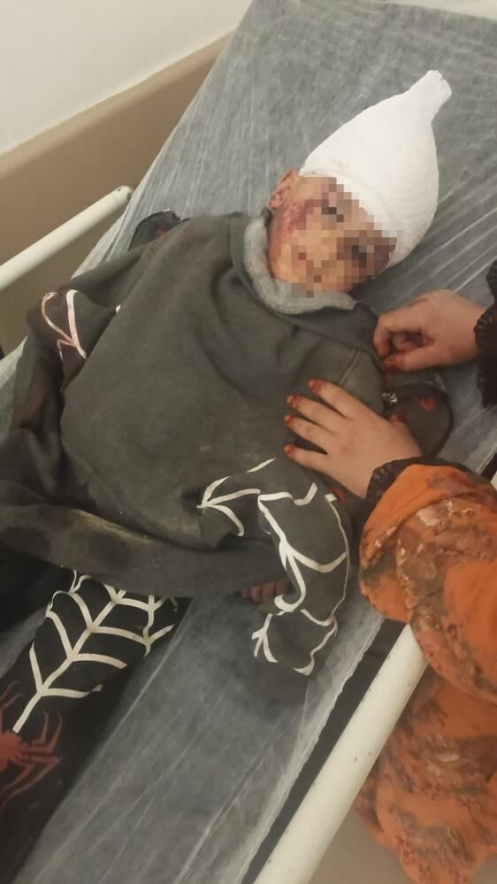 Sokakta Oyun Oynuyordu Biranda Hayati Karardi 3 Yasindaki Cocuk 12 Gunde 3 Ameliyat Ge (2)