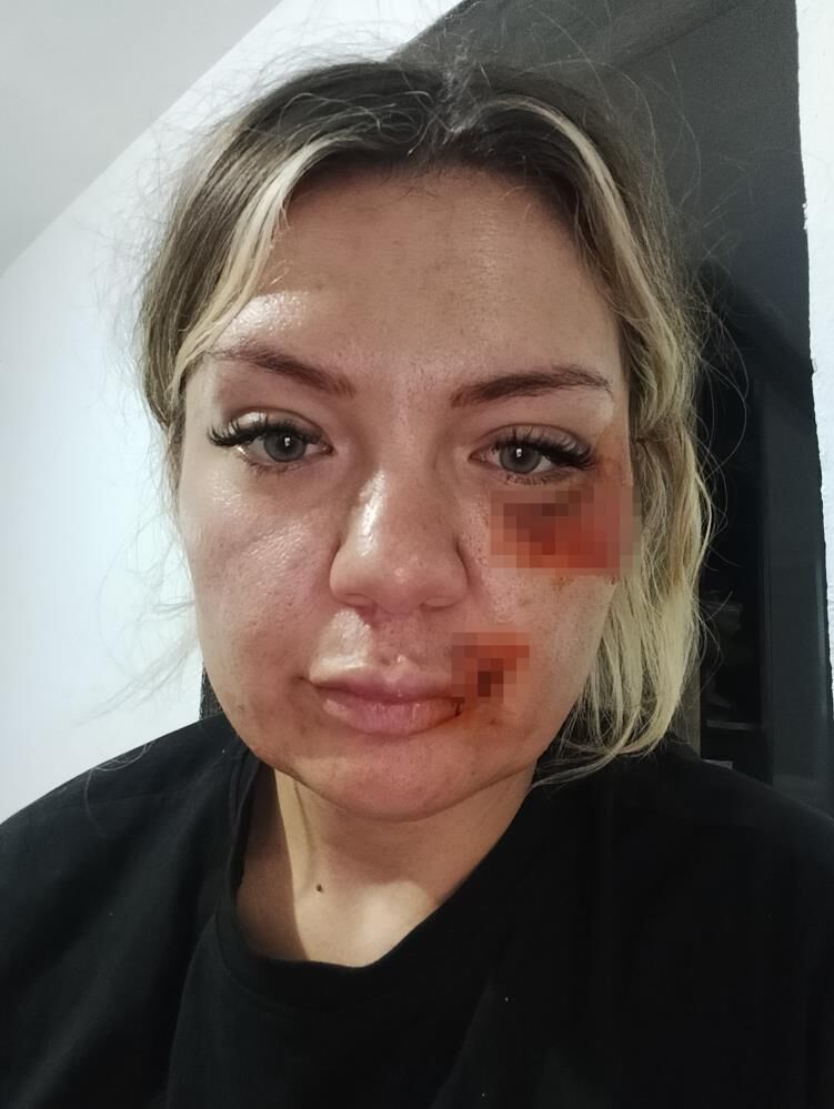 Bıçaklı Saldırıya Uğrayan Kadın Yaşadıklarını Anlattı Bıçak Kırılmasaydı Yaşayamazdım (2)