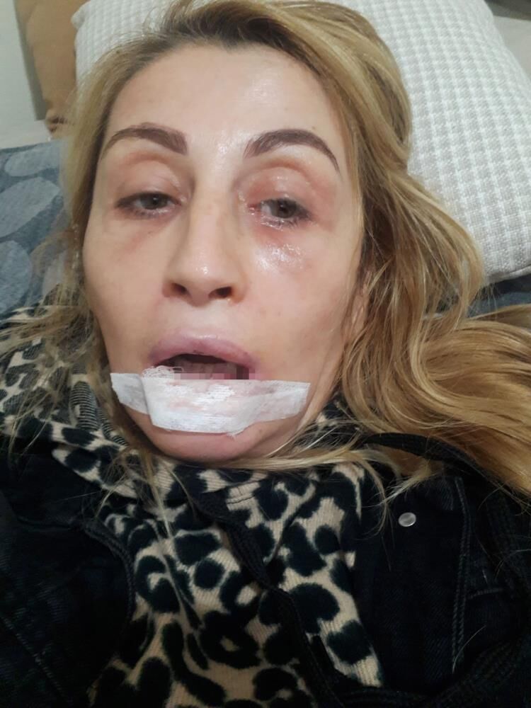 Gulusum Yok Yemek Yemek Problem Estetik Sonrasi Hayati Degisti (4)